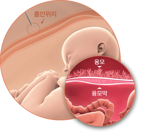 융모막 융모 검사(Chorionic Villus Sampling, CVS)