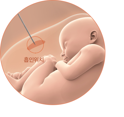 융모막 융모 검사(Chorionic Villus Sampling, CVS)
