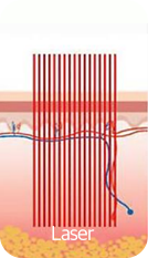 Fraxis Fractional Laser (두 가지 장점을 모두 갖춘 레이저)